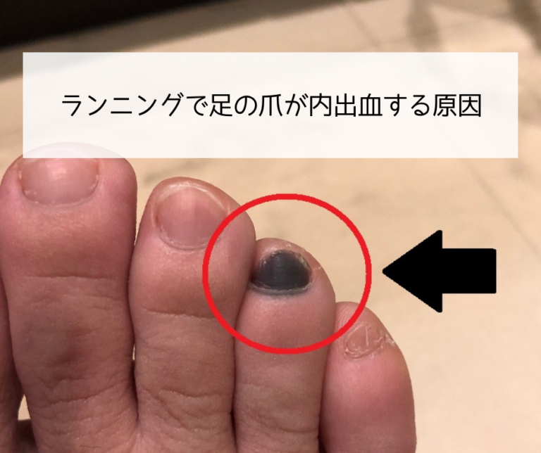 足 の 指 の 爪 内出血